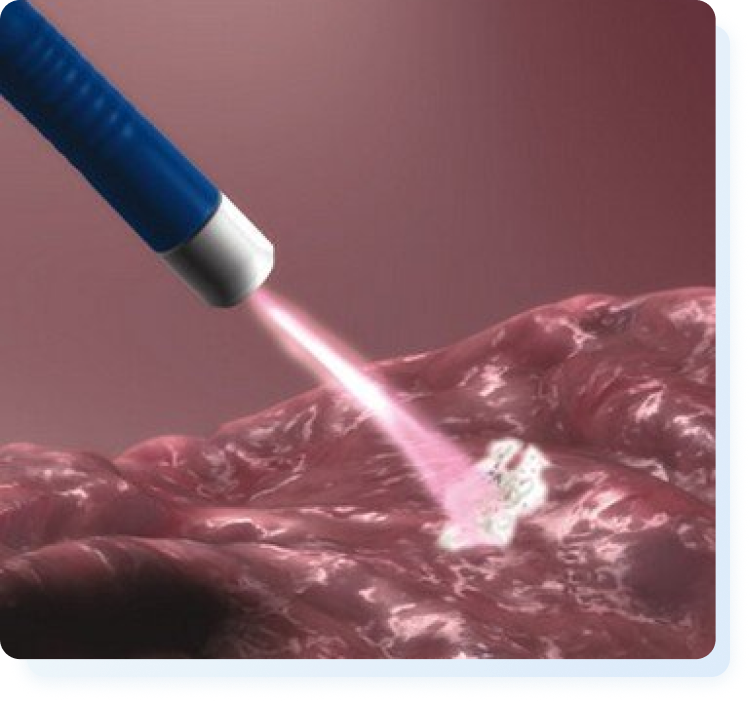 Indicação Plasma de Argônio