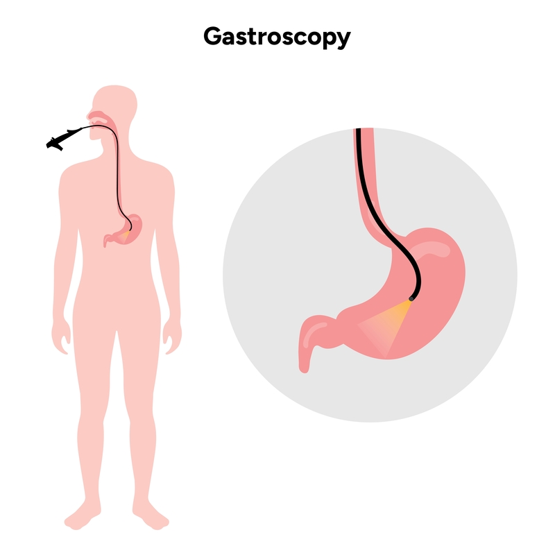 Miotomia  Endoscópica Peroral  (POEM)